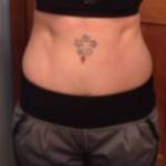 Mini tummy tuck operation pictures gallery