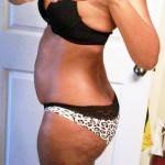 Mini tummy tuck pictures after pregnancy