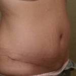 Mini tummy tuck pictures and images