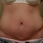 Mini tummy tuck pictures and photos