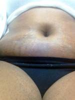 Mini tummy tuck pictures belly button