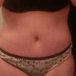 Mini tummy tuck pictures belly button photo