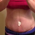 Mini tummy tuck pictures images