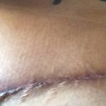 Mini tummy tuck pictures keloid scar
