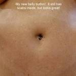 Mini tummy tuck pictures on line