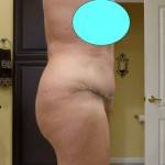 Mini tummy tuck pictures online photo