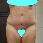 Mini tummy tuck pictures online photos
