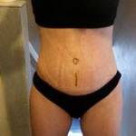 Mini tummy tuck pictures scar belly button