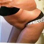 Mini tummy tuck pictures stretched skin