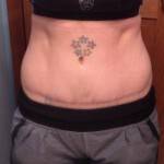Mini tummy tuck pictures surgery image