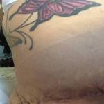 Mini tummy tuck pictures with tattoo