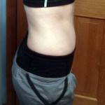 Mini tummy tuck recovery pictures