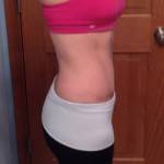 Mini tummy tuck recovery pictures after