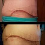 Photos of tummy tuck scars (13)