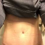 Photos of tummy tuck scars (18)