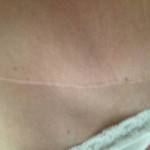 Photos of tummy tuck scars (23)