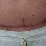 Photos of tummy tuck scars (30)