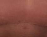 Photos of tummy tuck scars (34)