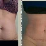 Photos of tummy tuck scars (35)