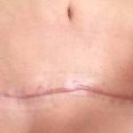Photos of tummy tuck scars (37)