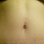 Photos of tummy tuck scars (4)