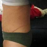 Photos of tummy tuck scars (41)