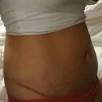 Photos of tummy tuck scars (42)