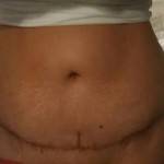 Photos of tummy tuck scars (43)