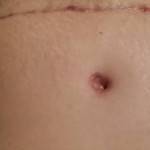 Photos of tummy tuck scars (47)