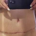 Photos of tummy tuck scars (50)