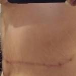 Photos of tummy tuck scars (51)