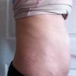Photos of tummy tuck scars (54)