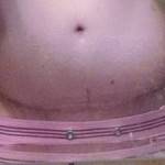 Photos of tummy tuck scars (56)