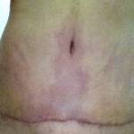 Photos of tummy tuck scars (57)