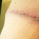 Photos of tummy tuck scars (6)