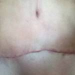 Photos of tummy tuck scars (64)