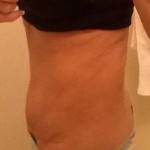 Photos of tummy tuck scars (65)