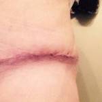 Photos of tummy tuck scars (7)