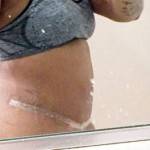 Photos of tummy tuck scars (9)