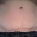 Photos of tummy tuck scars after
