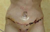 Recovery time tummy tuck scar