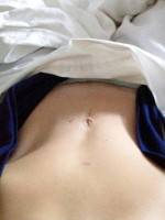 Skin only tummy tuck image