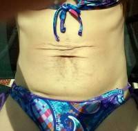 Stretch marks and tummy tuck surgery