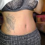 Tattoo after tummy tuck images