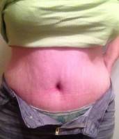 The Low scar tummy tuck