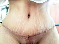The loose skin after tummy tuck