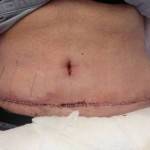 Tummy tuck abdominoplasty results pictures and photos