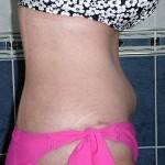 Tummy tuck abdominoplasty with liposuction before and after