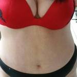 Tummy tuck and breast aug results pictures