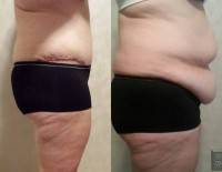 Tummy tuck procedure on obese patients